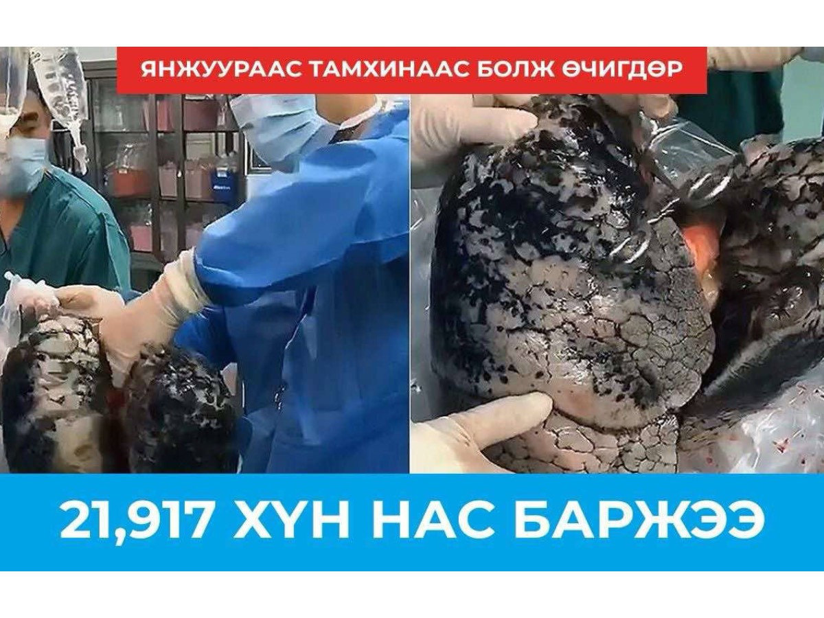 Дэлхий дахинаа өчигдөр янжуур тамхинаас үүдэлтэй өвчлөлөөр 21,917 хүн нас баржээ